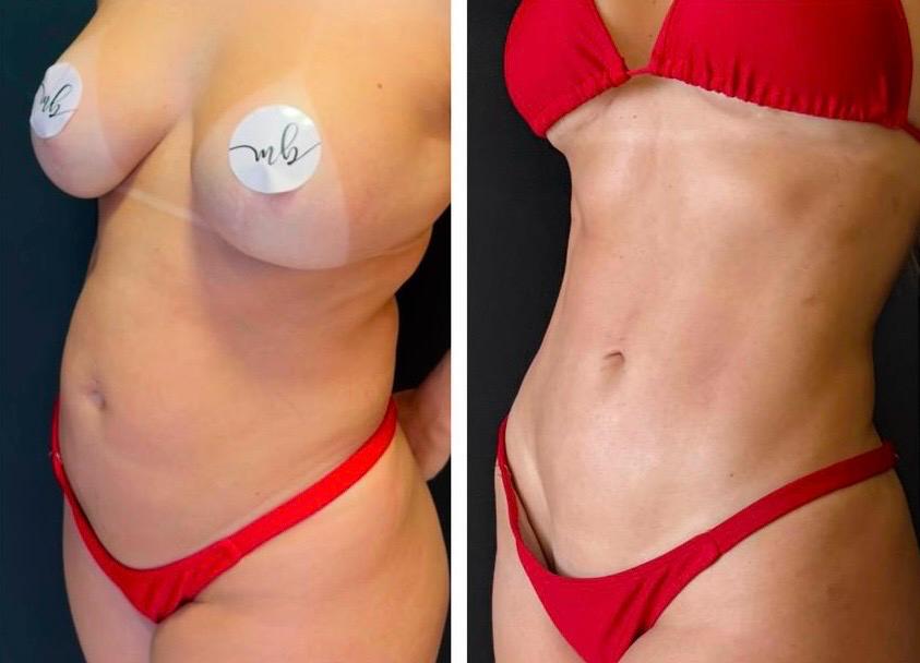 Lipoabdominoplastia com definição abdominal e cicatriz discreta